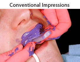 Conventional Impressions